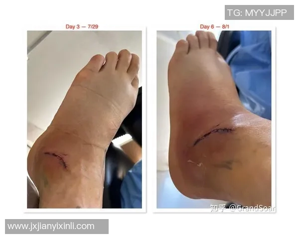 林葳脚踝腓前韧带轻微撕裂预计康复期为一个月的详细分析与建议